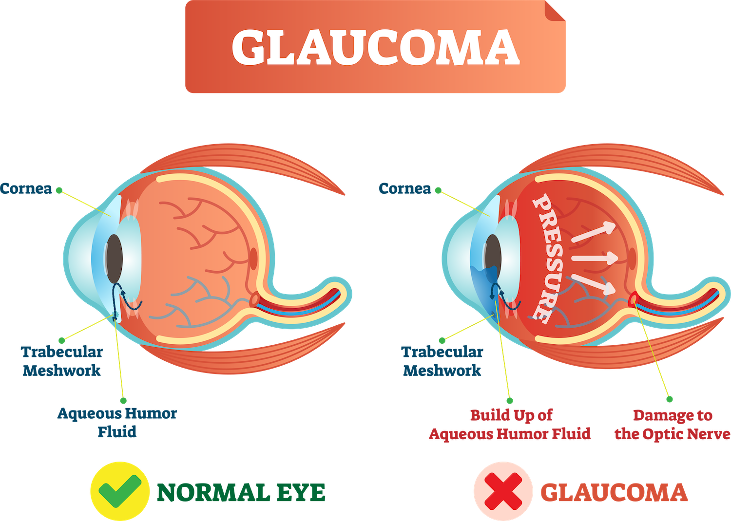 Glaucoma and how it effects your eye